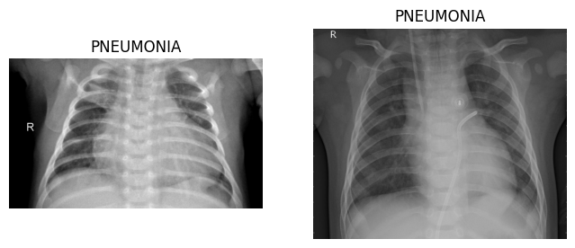 Pneumonia X-Ray